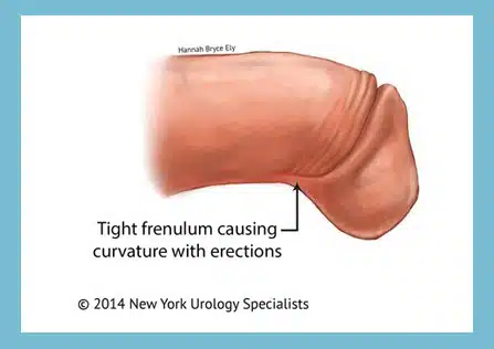 Penile frenulectomy for curve Illiwara